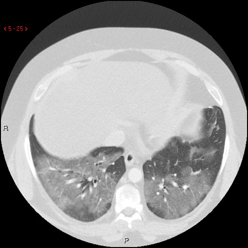 File:Non-specific interstitial pneumonitis (Radiopaedia 27044-27222 Axial lung window 16).jpg