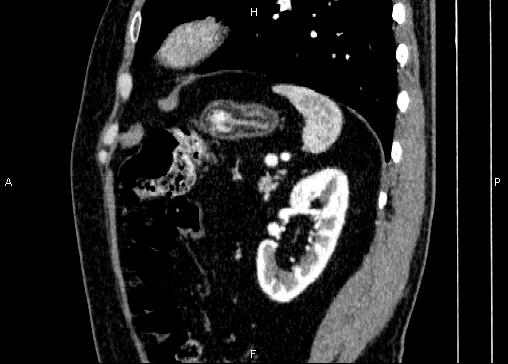 Non-syndromic pancreatic endocrine tumor (Radiopaedia 86958-103178 E 76).jpg