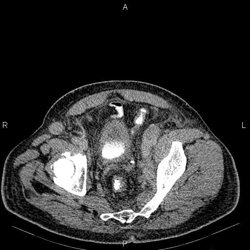 Non Hodgkin lymphoma in a patient with ankylosing spondylitis (Radiopaedia 84323-99621 Axial C+ delayed 71).jpg