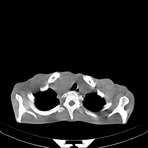 File:Non hodgkin lymphoma of the mediastinum (Radiopaedia 20814-20729 Axial non-contrast 5).jpg
