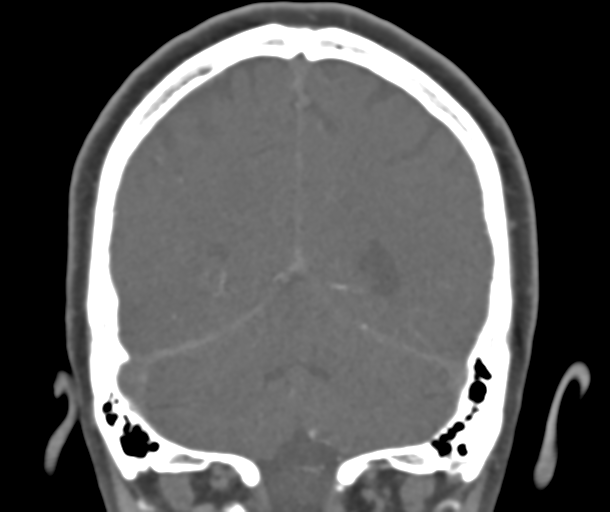 File:Normal CTA head (Radiopaedia 40801-43464 B 71).png