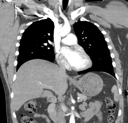 File:Normal CTA thorax (non ECG gated) (Radiopaedia 41750-44704 B 43).png