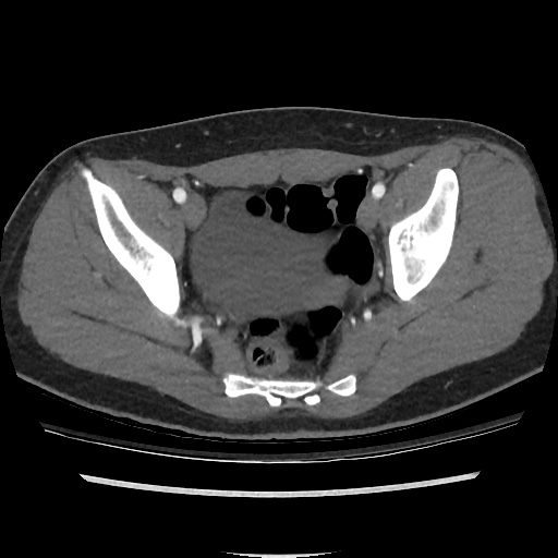 File:Normal CT angiogram of pelvis (Radiopaedia 45390-49430 A 39).jpg