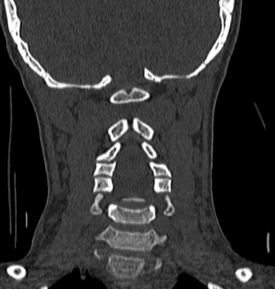 File:Normal CT cervical spine - 12-year-old (Radiopaedia 55352-61775 Coronal bone window 131).jpg