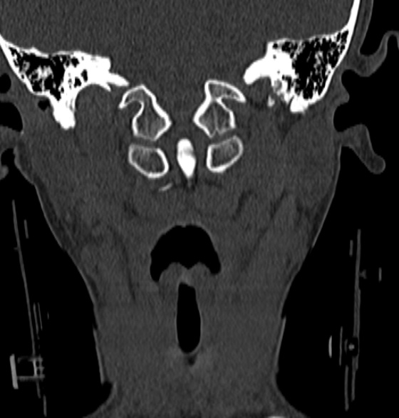 File:Normal CT cervical spine - 12-year-old (Radiopaedia 55352-61775 Coronal bone window 42).jpg
