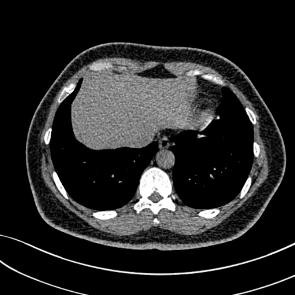Normal CT chest- adult female (Radiopaedia 52522-58428 Axial non-contrast 102).jpg