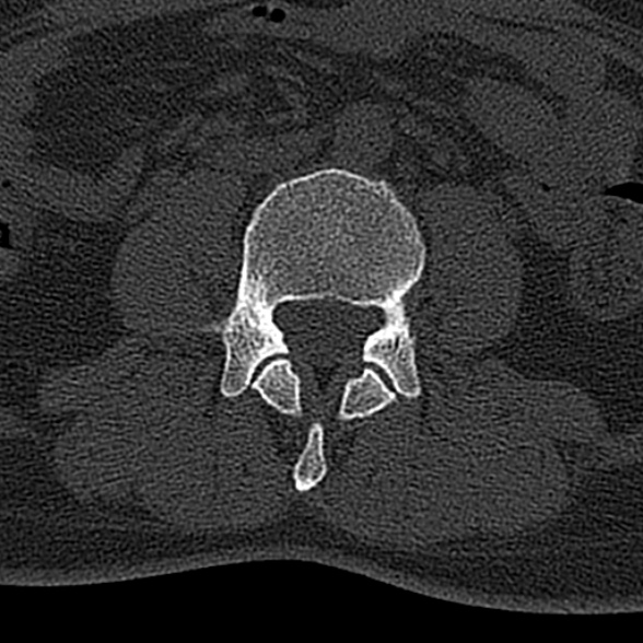 File:Normal CT lumbar spine (Radiopaedia 53981-60118 Axial bone window 43).jpg