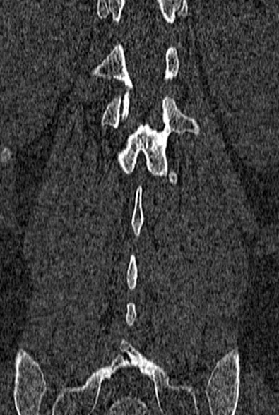 Normal CT lumbar spine (Radiopaedia 53981-60118 Coronal bone window 55).jpg
