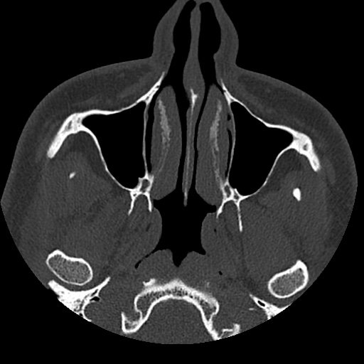 Normal CT paranasal sinuses (Radiopaedia 42286-45390 Axial bone window 82).jpg