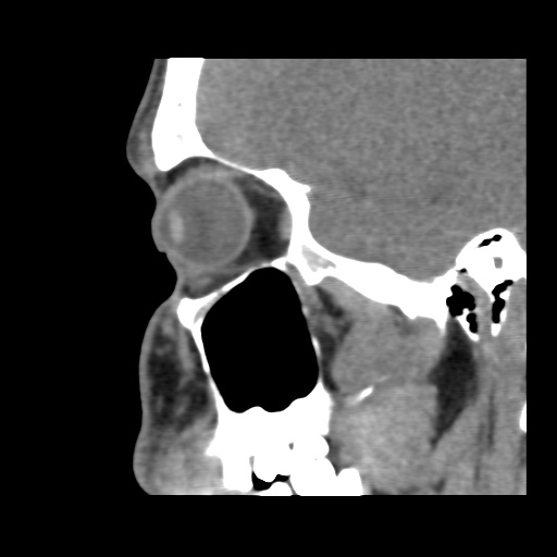 Normal CT paranasal sinuses (Radiopaedia 42286-45390 F 107).jpg