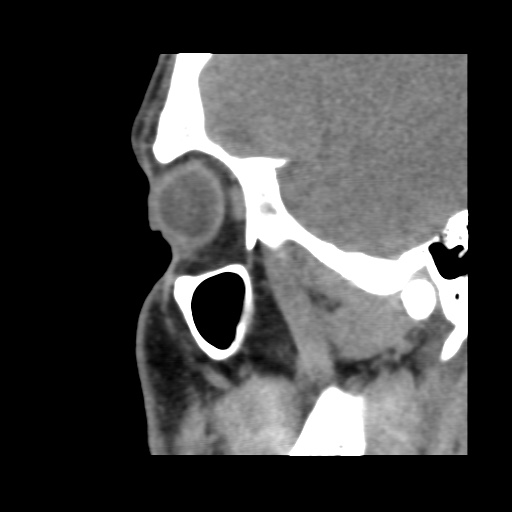 Normal CT paranasal sinuses (Radiopaedia 42286-45390 F 115).jpg