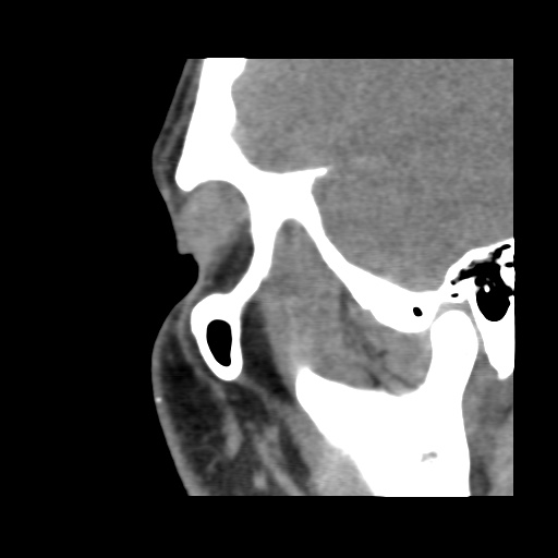 Normal CT paranasal sinuses (Radiopaedia 42286-45390 F 34).jpg