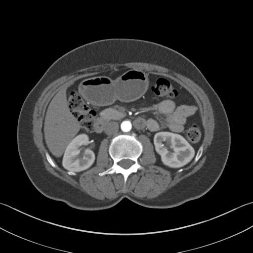 File:Normal CT renal artery angiogram (Radiopaedia 38727-40889 A 43).png