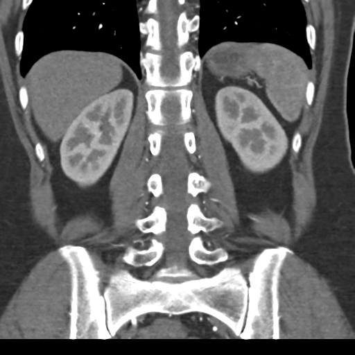 File:Normal CT renal artery angiogram (Radiopaedia 38727-40889 B 56).png