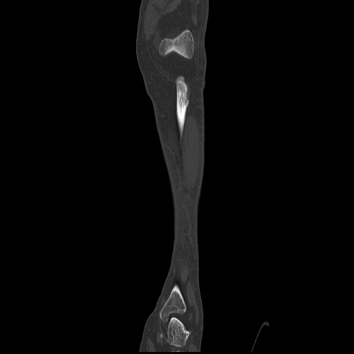 Normal CT tibia and fibula (Radiopaedia 51195-56848 Coronal non-contrast 23).jpg
