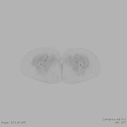 File:Normal F-18 FDG PET-CT (Radiopaedia 77382-89510 C 273).jpg