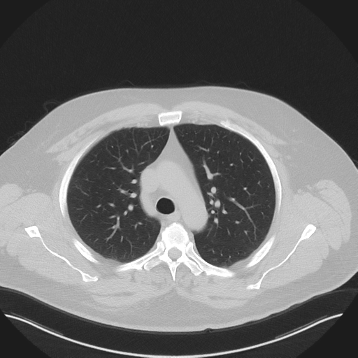 Normal HRCT (Radiopaedia 40797-43458 Axial lung window 19).png