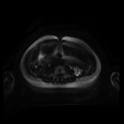 Normal MRI abdomen in pregnancy (Radiopaedia 88001-104541 Axial DWI 108).jpg