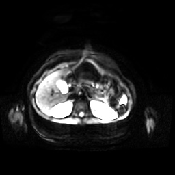 Normal MRI abdomen in pregnancy (Radiopaedia 88001-104541 Axial DWI 42).jpg