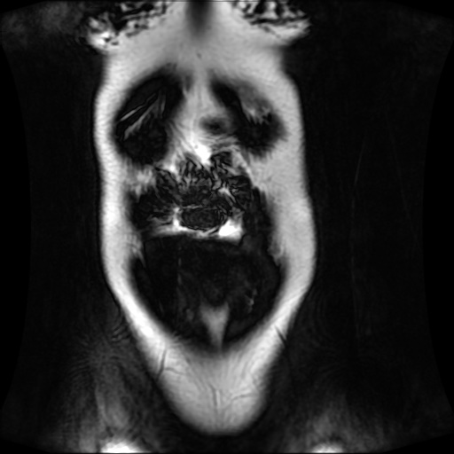 Normal MRI abdomen in pregnancy (Radiopaedia 88001-104541 N 29).jpg
