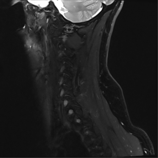 File:Normal MRI cervical spine (infection protocol) (Radiopaedia 53916-60039 Sagittal Dixon 15).png
