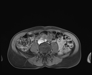 Normal adrenal glands MRI (Radiopaedia 82017-96004 M 69).jpg