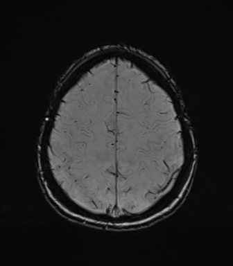 Normal brain MRI (TLE protocol) (Radiopaedia 40748-43405 Axial SWI 70).png