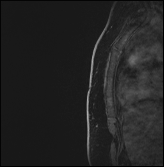 Normal breast MRI - dense breasts (Radiopaedia 80454-93850 I 186).jpg