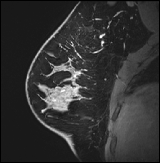 Normal breast MRI - dense breasts (Radiopaedia 80454-93850 I 59).jpg