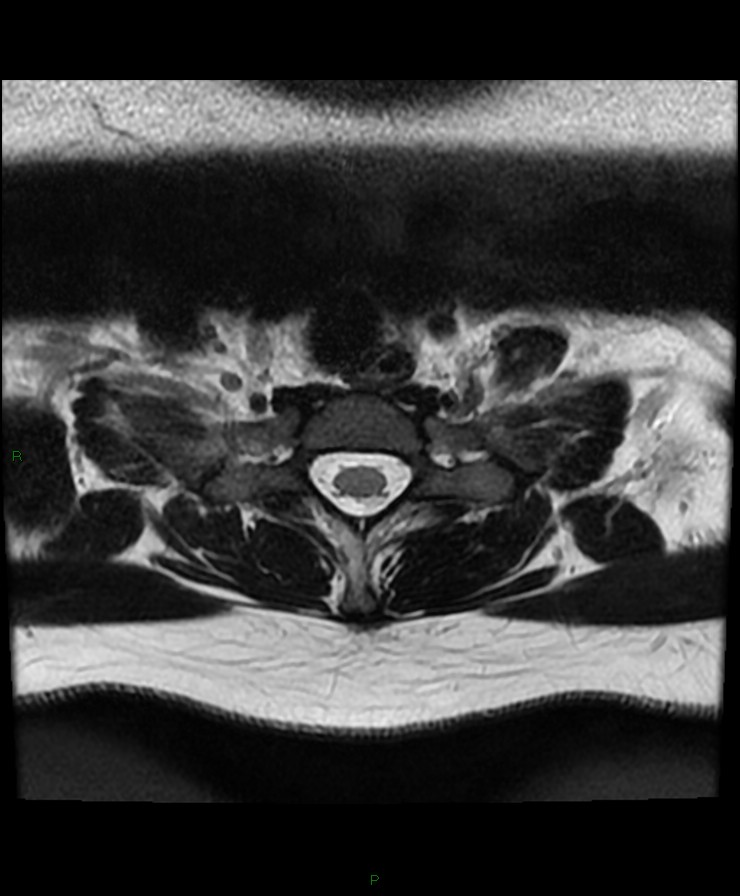 Normal cervical spine MRI (Radiopaedia 80146-93454 Axial T2 93).jpg