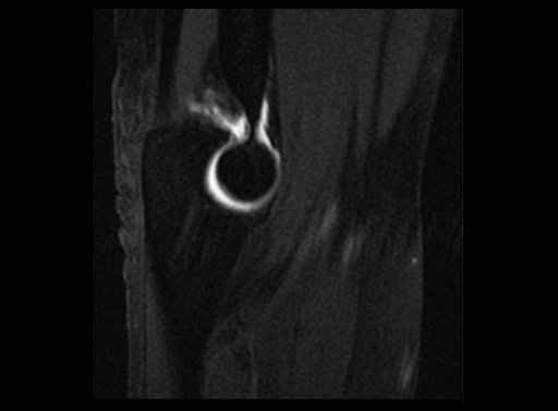 File:Normal elbow arthrograms (Radiopaedia 75550-86805 Sagittal T1 fat sat 10).jpg