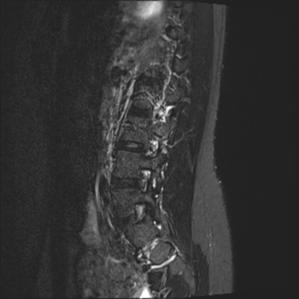 File:Normal lumbar spine MRI- 3 T (Radiopaedia 53280-59250 Sagittal STIR 19).jpg