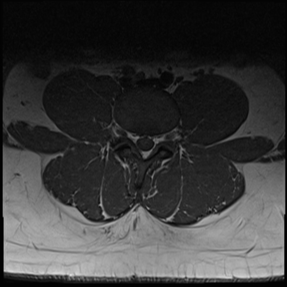 File:Normal lumbar spine MRI (Radiopaedia 47857-52609 Axial T1 16).jpg