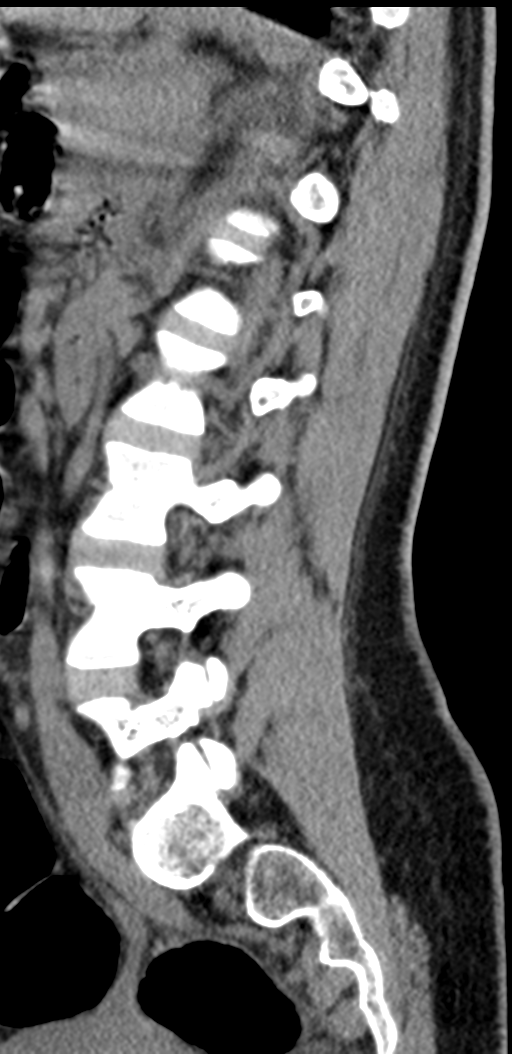 Normal lumbosacral CT (Radiopaedia 37923-39867 E 42).png