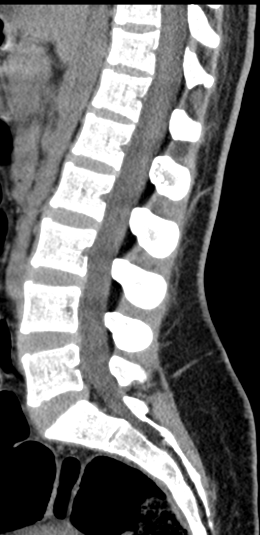 Normal lumbosacral CT (Radiopaedia 37923-39867 E 56).png