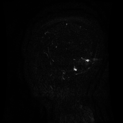 Normal noncontrast MR venography (Radiopaedia 87578-103957 A 144).jpg