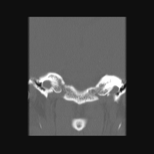 Normal sinus CT (annotated) (Radiopaedia 78917-91810 Coronal bone window 57).jpg