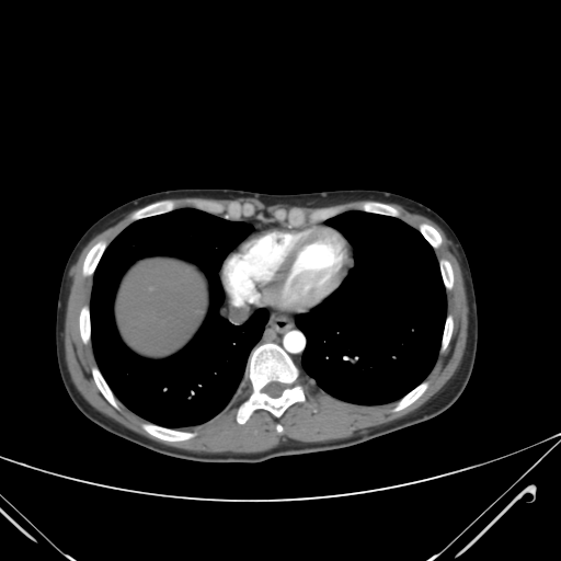File:Nutmeg liver- Budd-Chiari syndrome (Radiopaedia 46234-50635 A 4).png