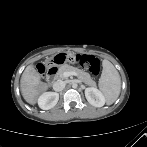 File:Nutmeg liver- Budd-Chiari syndrome (Radiopaedia 46234-50635 B 23).png