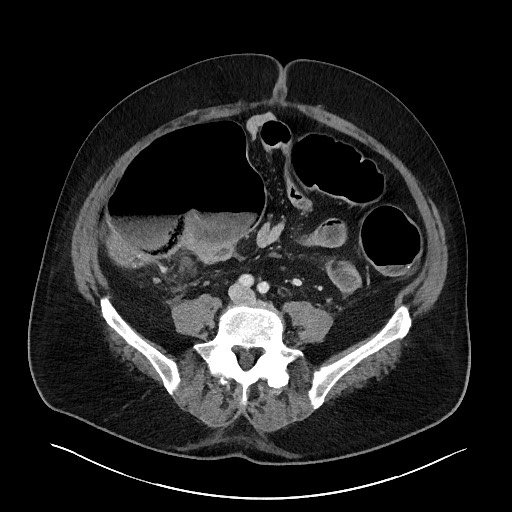 Obstructing sigmoid adenocarcinoma (Radiopaedia 58465-65619 A 109).jpg