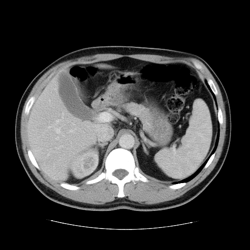 File:Obstructing ureteric calculus (Radiopaedia 18615-18514 B 16).jpg