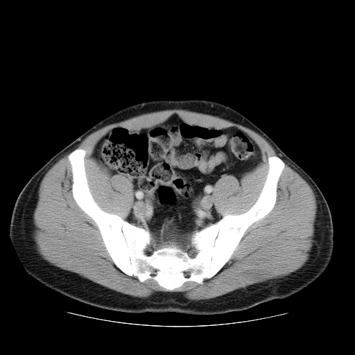 File:Obstructing ureteric calculus (Radiopaedia 18615-18514 B 44).jpg