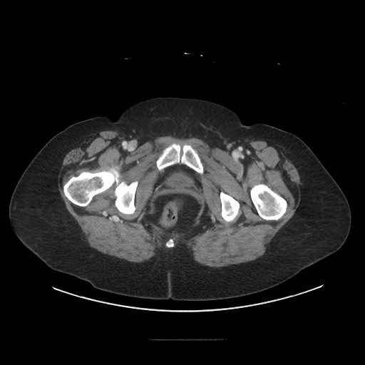 Obstructive distal colonic adenocarcinoma causing cecal perforation (Radiopaedia 86830-102989 A 192).jpg