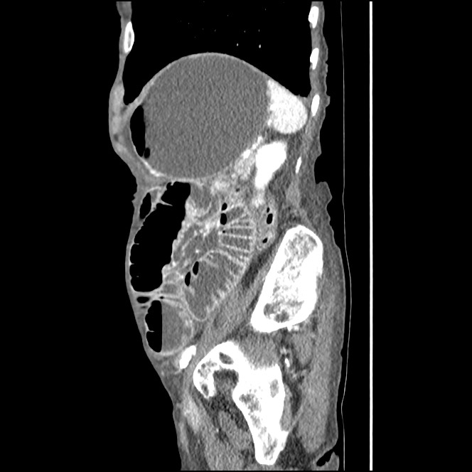 Obturator hernia causing small bowel obstruction (Radiopaedia 65522-74612 C 23).jpg