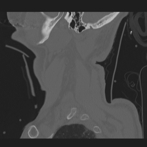 File:Occipital condyle fracture (Radiopaedia 33467-34517 Sagittal bone window 2).png