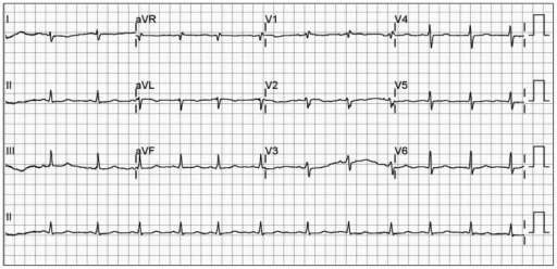 Right axis deviation ( and poor R-wave progression)
