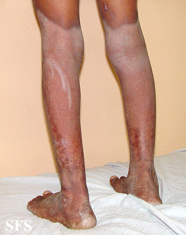 File:Pellagra (Dermatology Atlas 27).jpg
