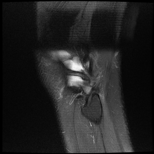 File:ACL acute full thickness tear - deep lateral femoral sulcus sign (Radiopaedia 38594-40740 Sagittal PD fat sat 21).jpg