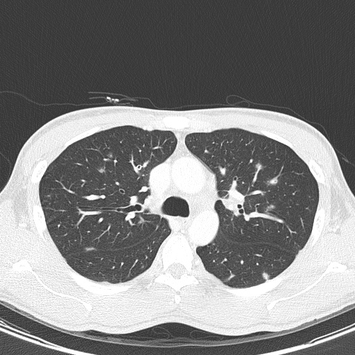 AIDS-related Kaposi sarcoma (Radiopaedia 85247-100811 Axial lung window 55).jpg