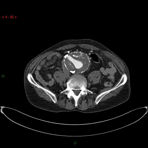 File:Abdominal aortic aneurysm (Radiopaedia 16155-15834 Axial C+ arterial phase 25).jpg